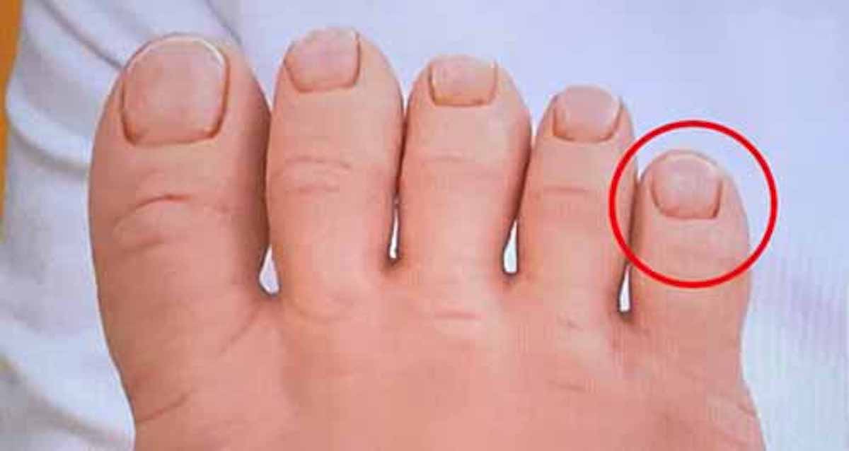 足の小指の爪が小さい人は腰痛 尿もれになる危険性 サタデープラス 17 04 01 何ゴト